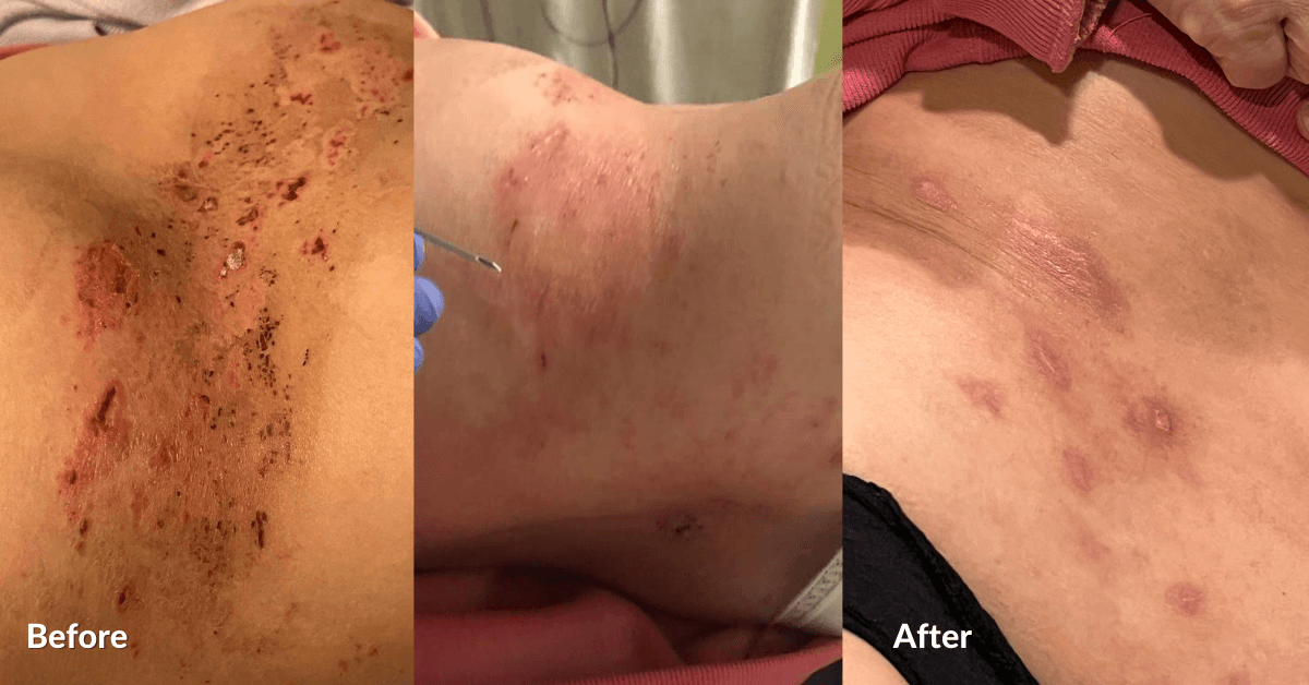 Successful Treatment of Skin Rash with Chinese Medicine